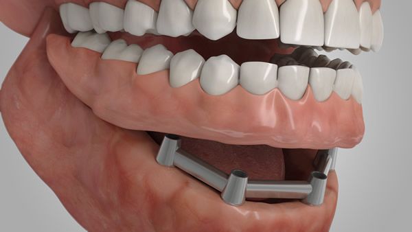 Illustration eines Implantats als Ersatz ganzer Zahnreihen